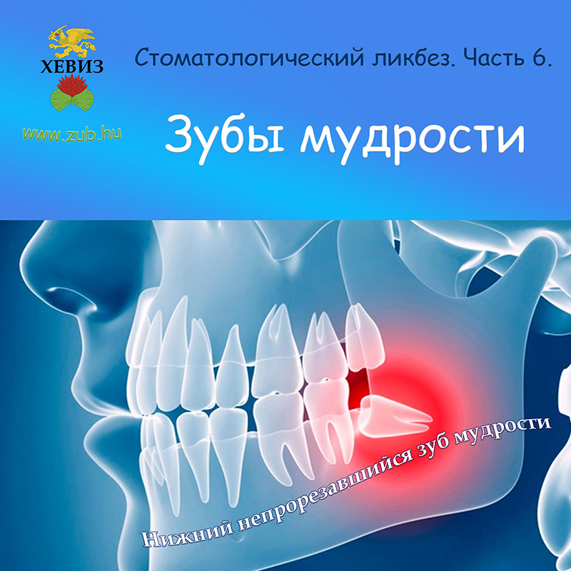 Стоматологический ликбез. Часть 6. Зубы мудрости