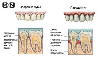 Пародонтит - заболевание зубов и десен