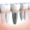 Имплантация одного зуба